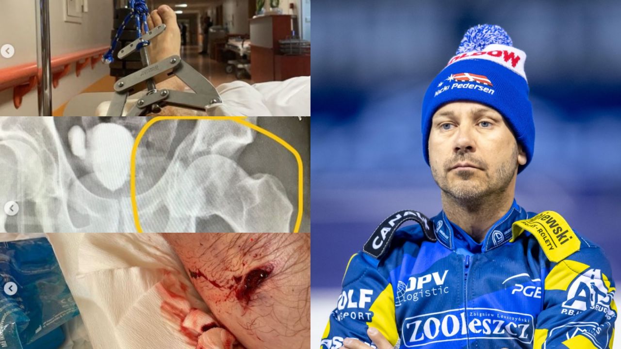 Nicki Pedersen opublikował zdjęcia swojej nogi (fot. Instagram/PAP).