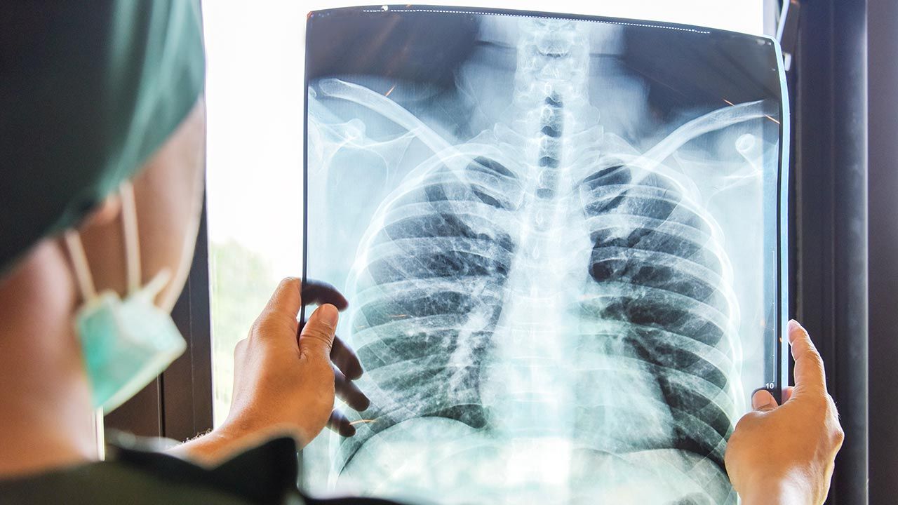 Działanie hamujące włóknienie płuc cząsteczki 1-MNA zostało potwierdzone w badaniach (fot. Shutterstock/Studio4dich)