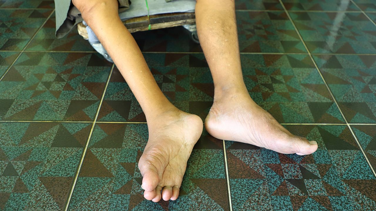 Wirus polio w ściekach. Pierwszy taki przypadek od trzydziestu lat